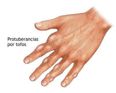 Protuberancias por tofos, manifestación clínica de la gota